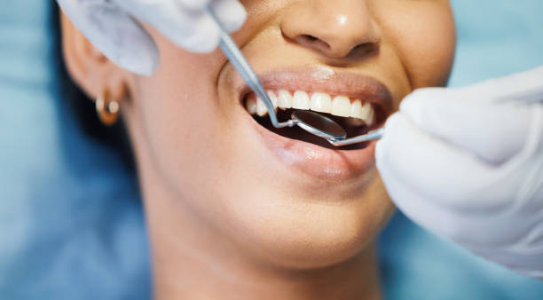 Best Emergency Wisdom Tooth Extraction in Lake Shastina, CA